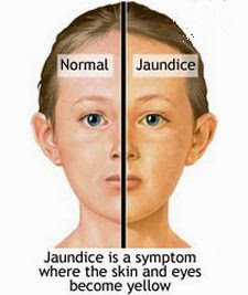 Jaundice-face.jpg