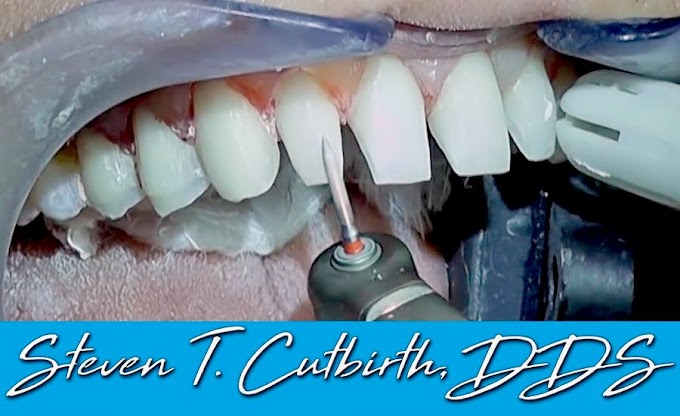 PROSTHODONTICS: Prepping Teeth for Veneers (In-Depth Instructions) - Steven T. Cutbirth, DDS
