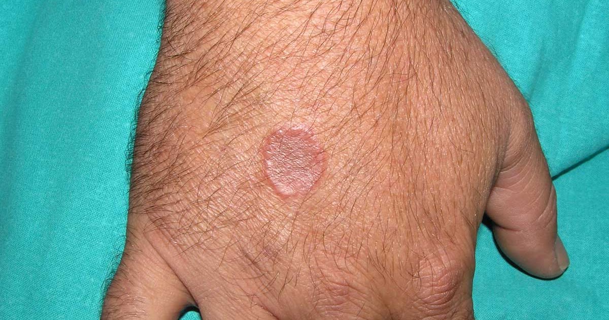 Blog Clínica Dermatológica Dr. E. Herrera: ¿Cómo afecta la diabetes a la piel?