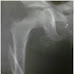Evaluation of Results of Intramedullary Fixation of Paediatric Fracture Shaft Femur by Titanium Elastic Nail