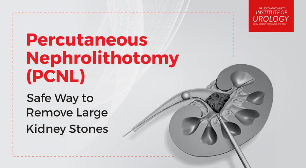 Laser surgery for kidney stone Percutaneous Nephrolithotomy for Kidney