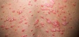 Penyakit Kulit Psoriasis Penyakit Kulit Psoriasis