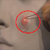 How To Properly Pop A Pimple Without Scarring