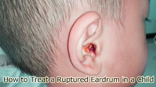 How to Treat a Ruptured Eardrum in a Child