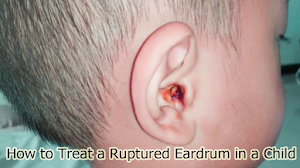 How to Treat a Ruptured Eardrum in a Child How to Treat a Ruptured Eardrum in a Child