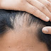 Pattern hair loss