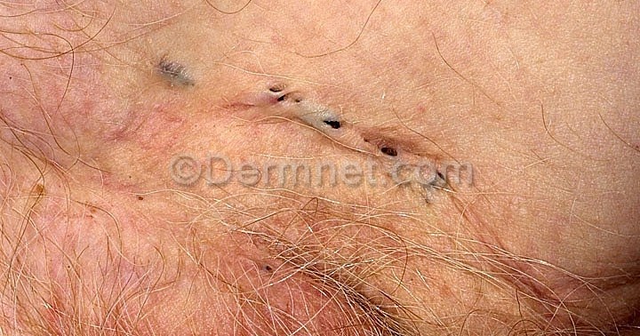 Medicine by Sfakianakis G. Alexandros Skin disease in Medicine by Sfakianakis G. Alexandros Skin disease in