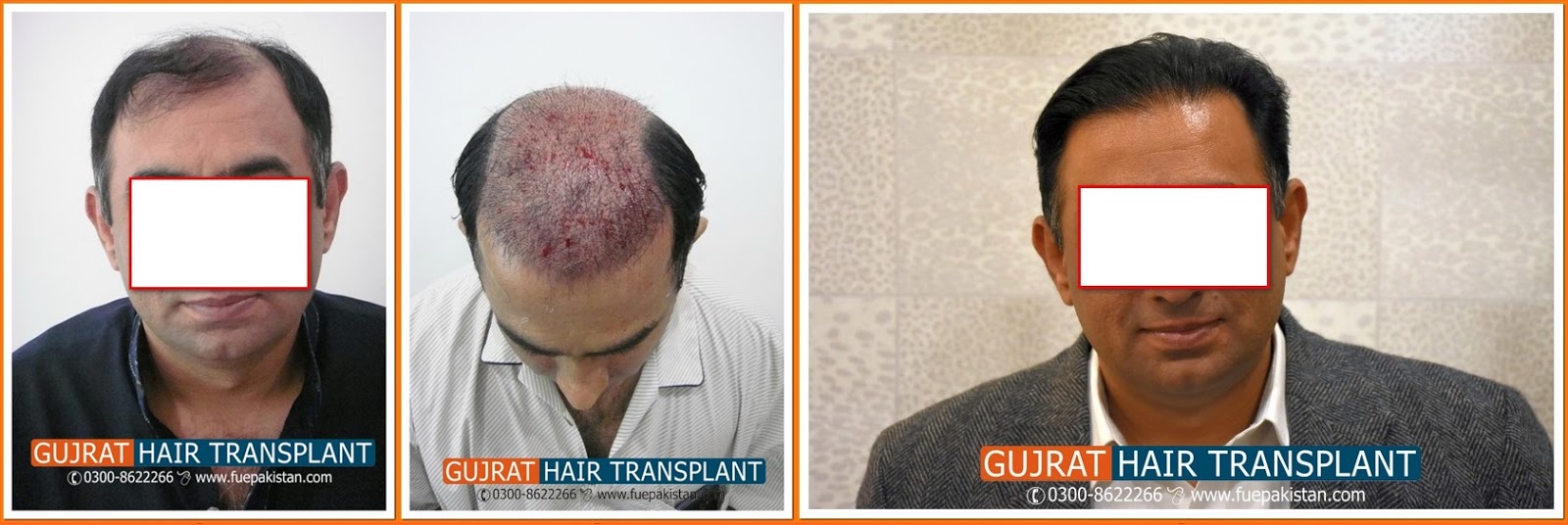 Follicular Unit Extraction Fue In Pakistan Fue Hair Transplant In
