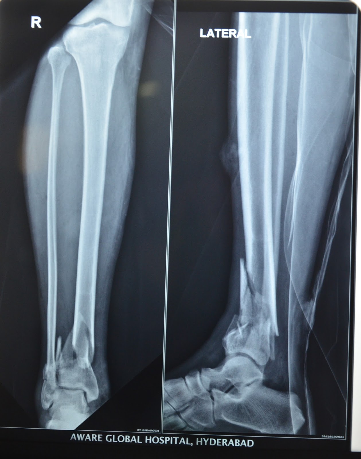 Fractures Of The Foot Fracture Treatment