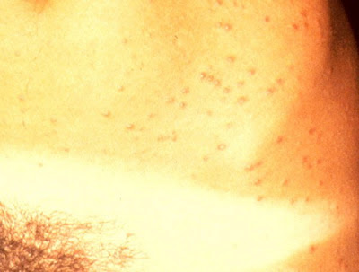 Syphilis Rash or STD Secondary Rash - Healthy Skin Care