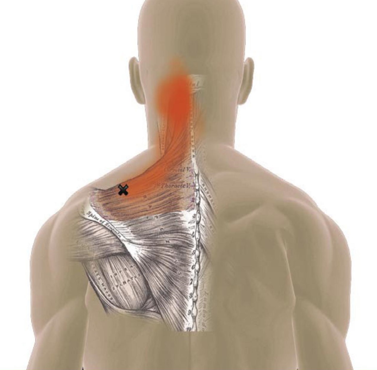 Затылок шею плечи. Trapezius мышца триггерная. Плечелопаточный периартрит триггерные точки. Спазм трапециевидной мышцы. Спазмированные мышцы шеи.