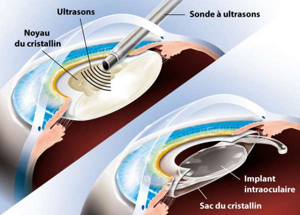 Opération de la cataracte : implant monofocal ou multifocal