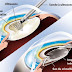 Opération de la cataracte : implant monofocal ou multifocal