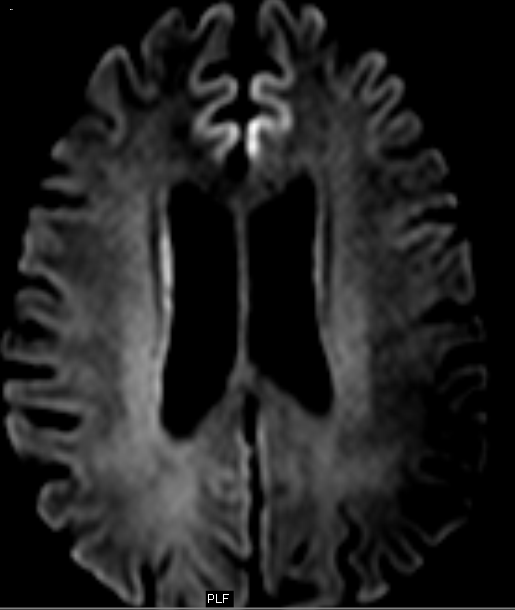CreutzfeldtJacob disease Teaching Points Sumer's Radiology Blog