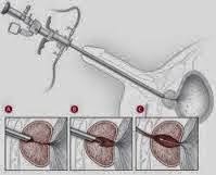 Rezecția transuretrală a prostatei în mediu salin - Royal Hospital