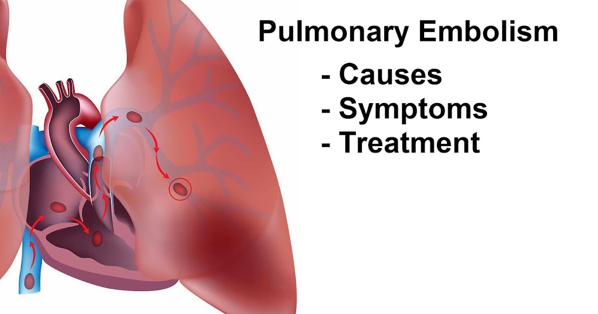 Pulmonary Embolism (Blood Clot In Lung) Causes, Signs And Symptoms