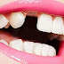 Không nhổ răng khi niềng răng có thực sự hiệu quả không?