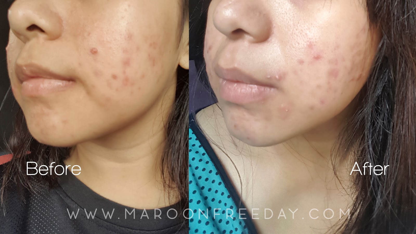 Review H2 Pure Skin Suplemen Untuk Kulit Sehat Maroon Freeday