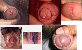 Image Pengobatan Kencing darah Dan Nanah Herbal