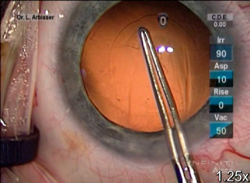 What You Need To Know Before Cataract Surgery in 2016 - Eyedolatry