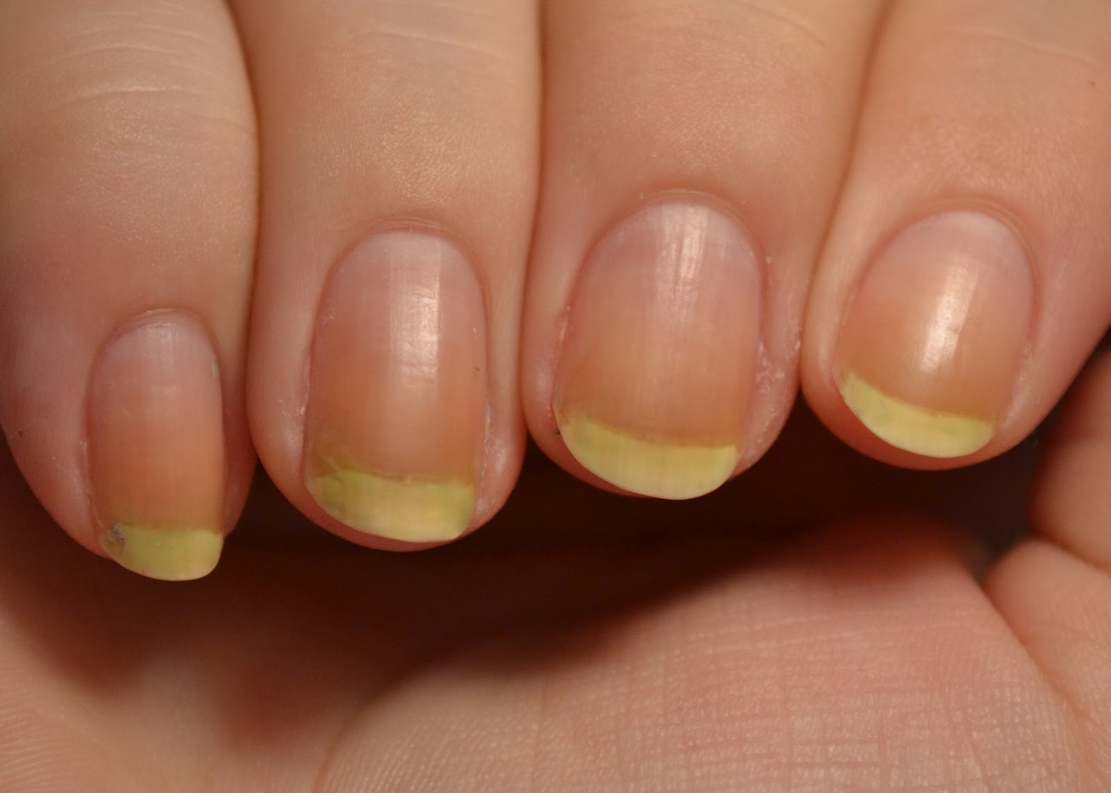 What Are Beau's Lines? - Health - NAILS Magazine