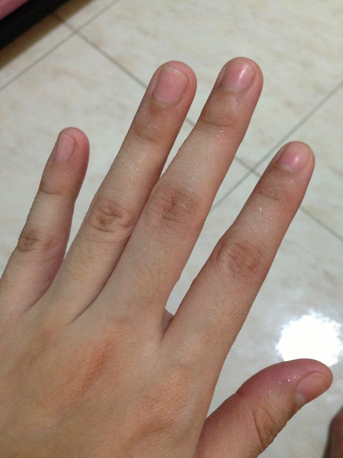 palmar hyperhidrosis