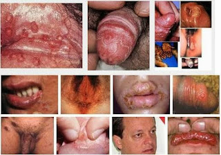 Pengobatan Herbal Penyakit Sipilis Pengobatan Herbal Penyakit Sipilis