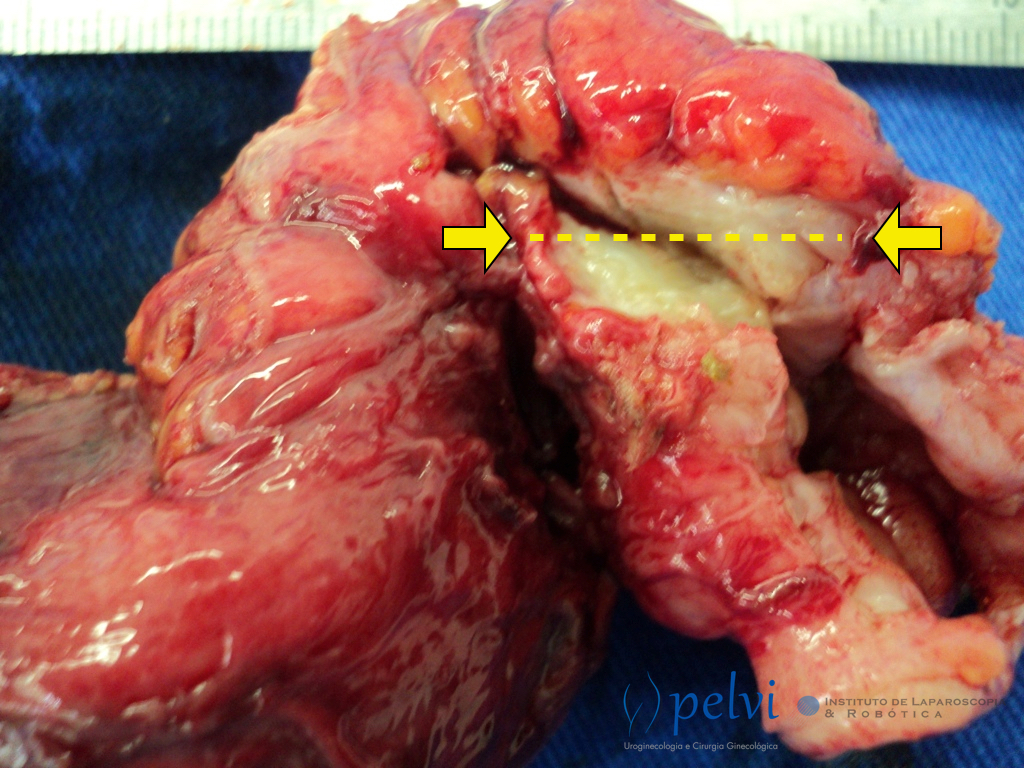 Qual exame para detectar endometriose