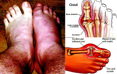 obat asam urat dan kolestrol yang ampuh