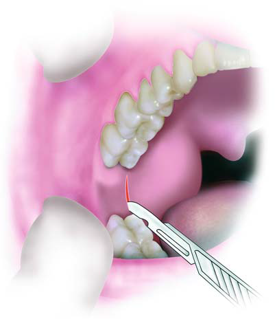 Dentistry And Medicine Pterygomandibular Abscess Anatomic