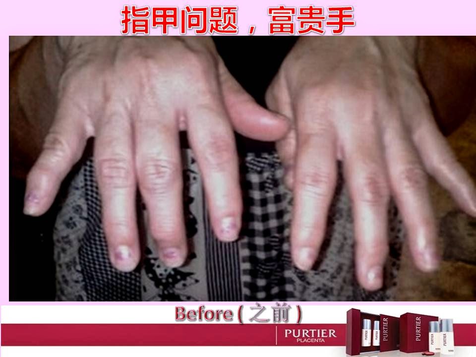 FINGER NAILS DISORDER, SKIN DISEASE (PSORIASIS/ACZEMA/CUTANEOUS CONDITION)