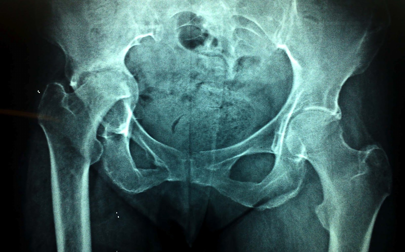 O R T O C R I T I C A Necrosis Avascular de Cadera en