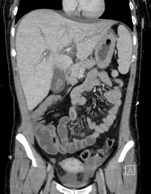 Acut hepatitis