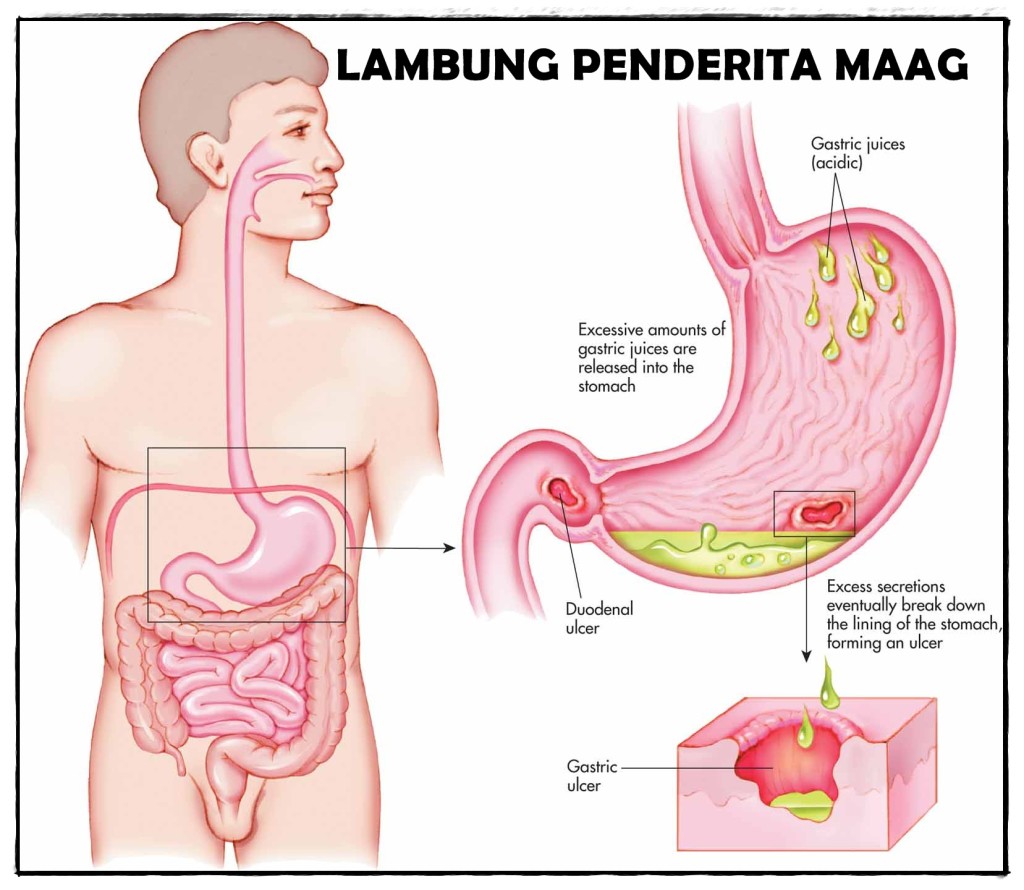 Gudang Ilmu Laporan Pendahuluan Lp Konsep Dasar Askep Gastritis Maag