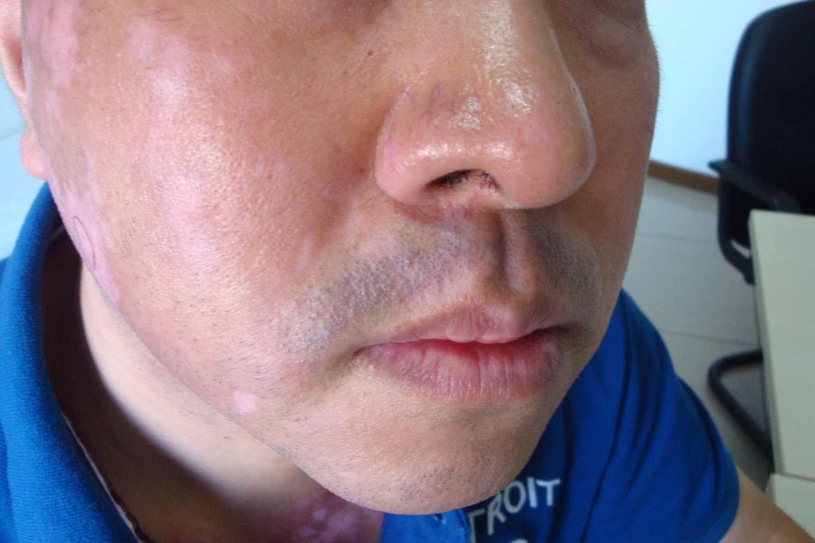 Chines Medicine Treatment for Vitiligo: Vitiligo Treatment : Is