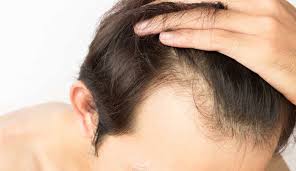 3 Best Hair Restoration In 2018