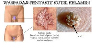 Seperti Apa Ciri Kutil Kelamin Pada Wanita Bagaimana Ciri Kutil Kelamin Pada Wanita