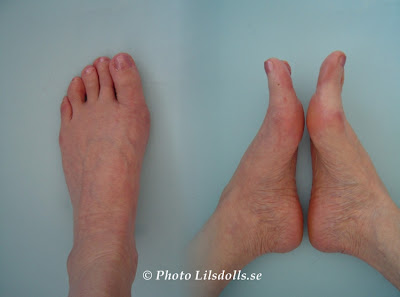 hallux valgus, halluxvalgus-operation, andra resutat