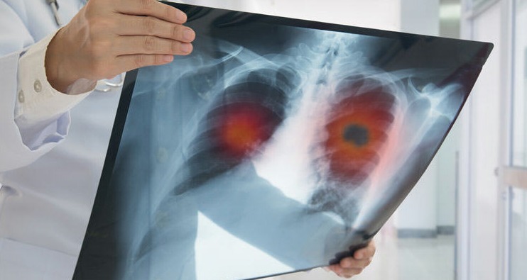 What is Mesothelioma Lung Cancer