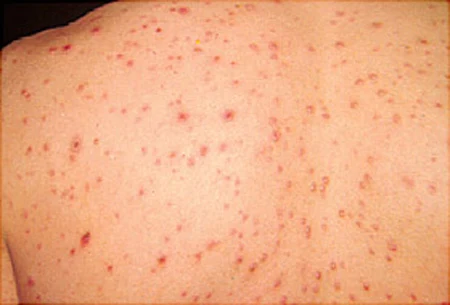 Chickenpox spread in Alappuzha, Alappuzha, News, Health, Health & Fitness, Warning, hospital, Treatment, Family, Doctor,Kerala.