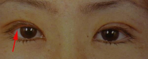 Eyelid Surgery by Prof Dr CN CHUA 蔡鐘能: Complications of Double Eyelid ...