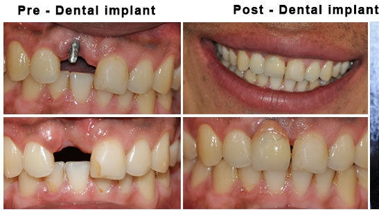 dental implant Italy costs 1000 USD HCMC Vietnam nha khoa thuan kieu before after 2019 2020 dental implant Italy costs 1000 USD HCMC Vietnam nha khoa thuan kieu before after 2019 2020