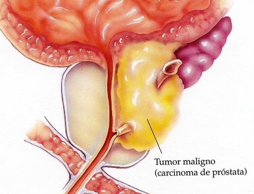 Cáncer de Próstata - Urología de mínima invasión