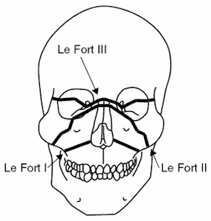 ABC Radiology Blog: Le Fort Classification