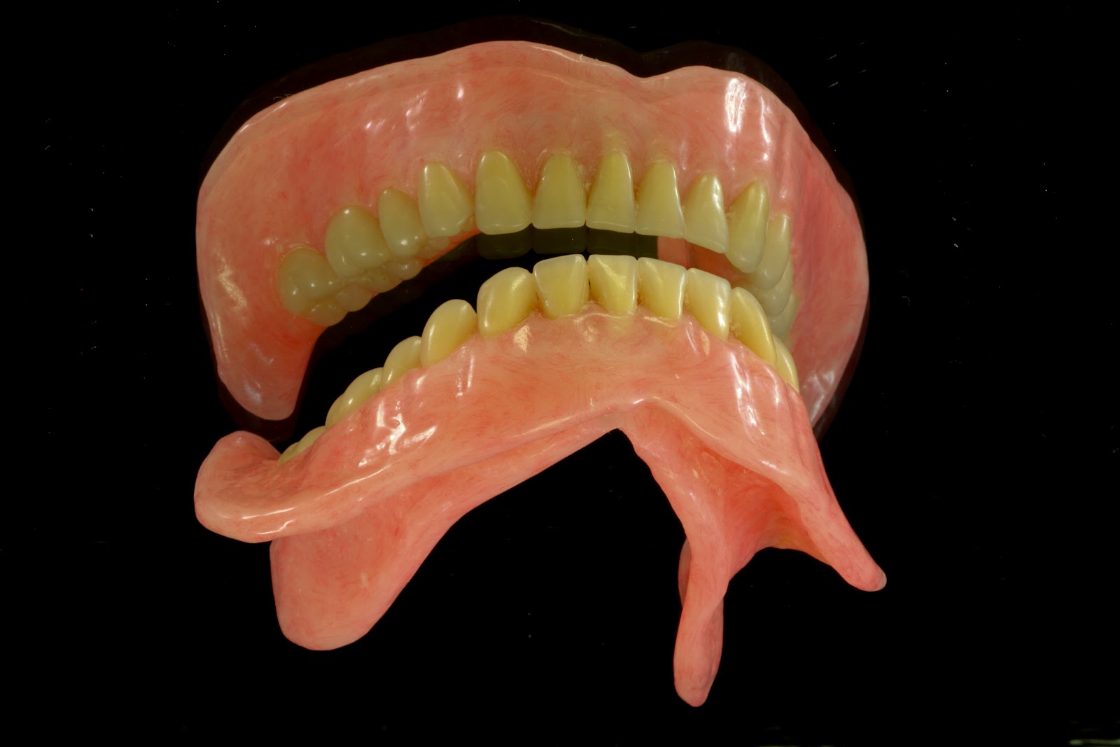 Boise Idaho Prosthodontics Mandibular Implant Overdenture Surgical Guide