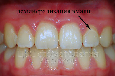 брекеты портят зубы