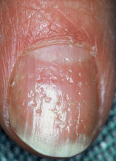 Nail pitting: Nail pitting causes