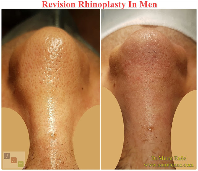Revision Nose Job Surgery For Men in Istanbul - Revision Male Rhinoplasty in Istanbul - Men's Revision Rhinoplasty in Turkey - Revision Nose Reshaping For Men in Istanbul - Mens Revision Rhinoplasty in Istanbul - Revision Nose Job Rhinoplasty For Men in Istanbul - Best Revision Rhinoplasty For Men Istanbul - Revision Nose Aesthetic For Men in Istanbul - Male Revision Nose Operation in Istanbul - Male Revision Rhinoplasty Surgery in Istanbul - Male Revision Rhinoplasty Surgery in Turkey - Male Revision Nose Aesthetic Surgery in Istanbul - Revision Rhinoplasty In Mens Istanbul