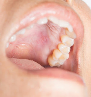 Tips for fighting sores in the mouth Tips for fighting sores in the mouth
