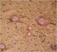 qué es molusco contagioso productos naturales artesanales